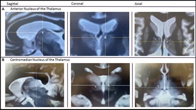 A multicenter retrospective study of patients treated in the thalamus with responsive neurostimulation